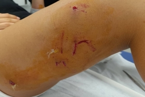 Αγέλη σκύλων επιτέθηκε σε 12χρονη στο Δρυμό